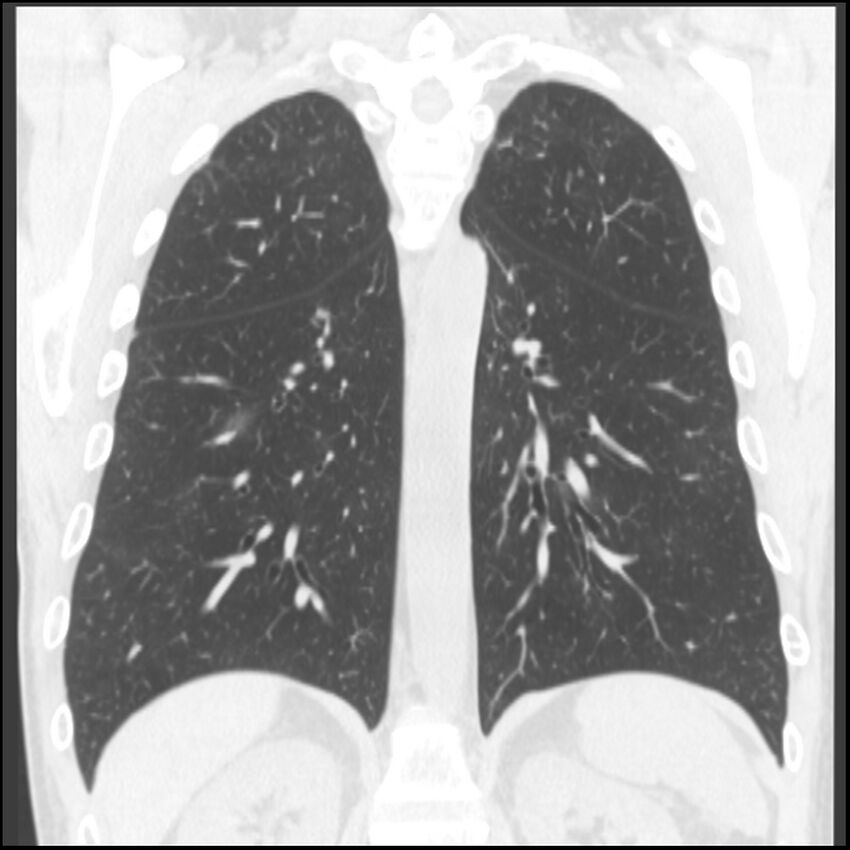 Angioinvasive aspergillosis (Radiopaedia 43957-47466 Coronal lung window 31).jpg