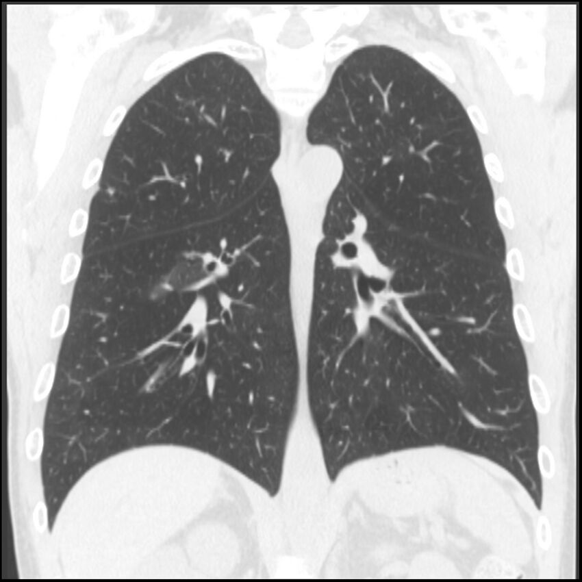Angioinvasive aspergillosis (Radiopaedia 43957-47466 Coronal lung window 37).jpg