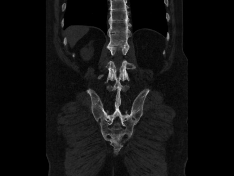File:Ankylosing spondylitis (Radiopaedia 44609-48357 Coronal bone window 81).jpg