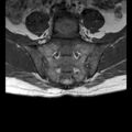 Ankylosing spondylitis with zygapophyseal arthritis (Radiopaedia 38433-40517 E 7).jpg