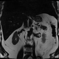 Annular pancreas (Radiopaedia 38292-40320 Coronal T2 9).png