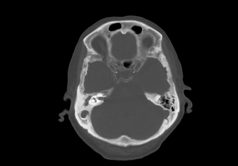 File:Anomalous intracranial venous drainage (Radiopaedia 28161-28418 Axial bone window 10).jpg