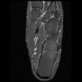 Anterior calcaneal process fracture (Radiopaedia 74654-85611 Axial PD fat sat 21).jpg