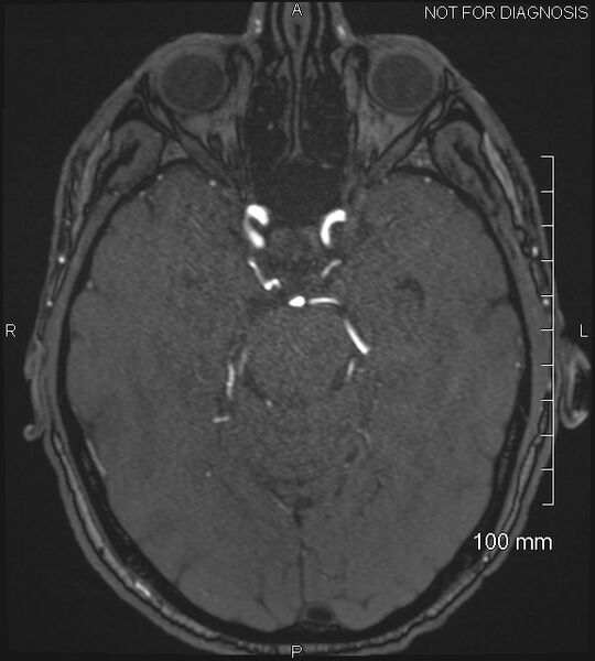 File:Anterior cerebral artery aneurysm (Radiopaedia 80683-94127 Axial MRA 87).jpg