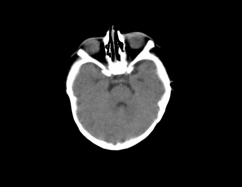 File:Anterior plagiocephaly (Radiopaedia 71836-82273 Axial non-contrast 5).jpg