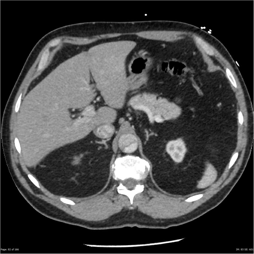 Aortic dissection- Stanford A (Radiopaedia 37759-39664 A 73).jpg