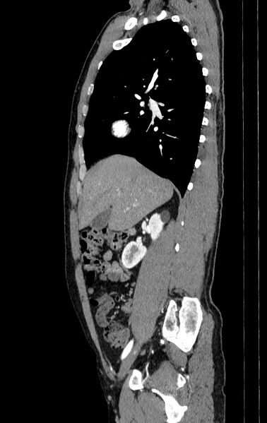 File:Aortic dissection - Stanford type A (Radiopaedia 83418-98500 B 2).jpg