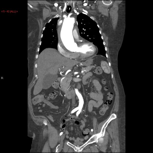 File:Aortic intramural hematoma (Radiopaedia 27746-28001 B 19).jpg