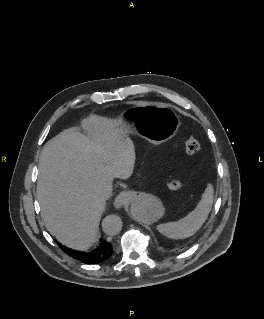 Aortic rupture (Radiopaedia 88822-105594 Axial non-contrast 206).jpg