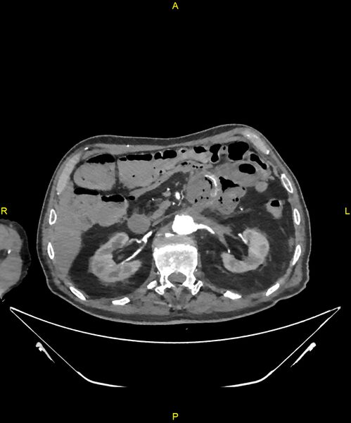 File:Aortoenteric fistula (Radiopaedia 84308-99603 B 111).jpg