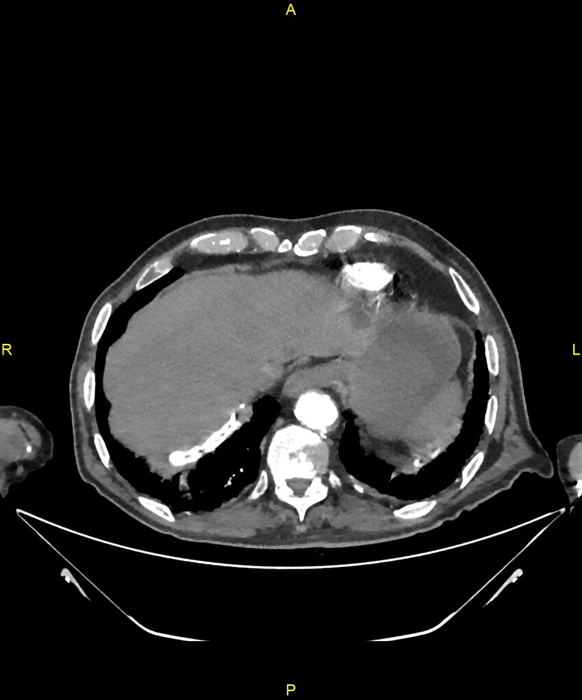 Aortoenteric fistula (Radiopaedia 84308-99603 B 26).jpg