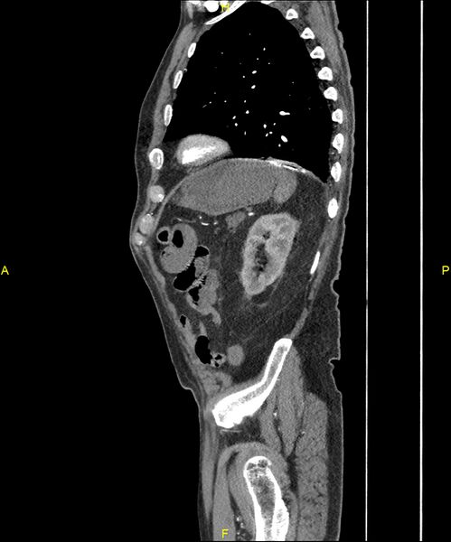 File:Aortoenteric fistula (Radiopaedia 84308-99603 C 268).jpg