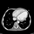 Aortopulmonary window, interrupted aortic arch and large PDA giving the descending aorta (Radiopaedia 35573-37074 B 67).jpg
