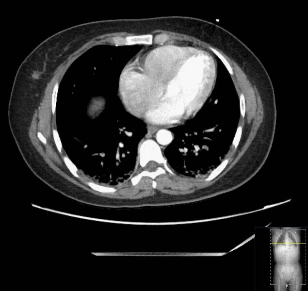 File:Appendicitis (CT angiogram) (Radiopaedia 154713-127660 Axial 186).jpg