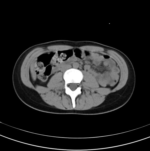 File:Appendicitis and incidental bicornuate uterus (Radiopaedia 22833-22853 Axial non-contrast 23).jpg