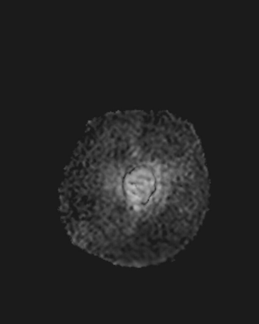 Appendicitis in gravida (MRI) (Radiopaedia 89433-106395 Coronal ADC 6).jpg