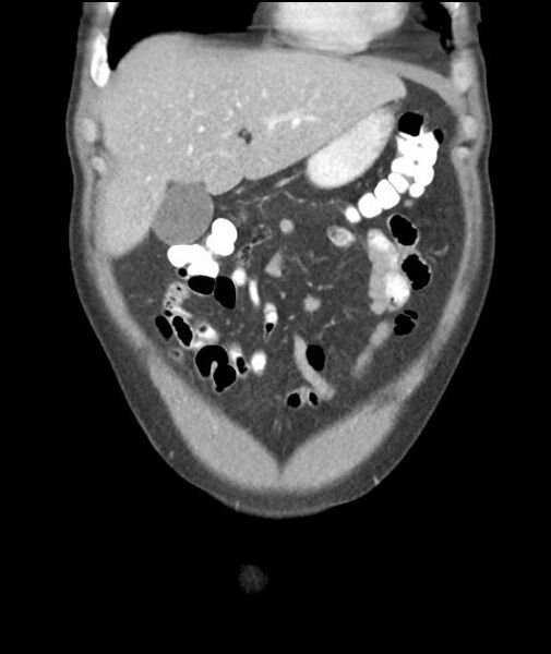 File:Appendicitis with cecal bar sign (Radiopaedia 31878-32830 A 17).jpg