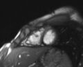 Arrhythmogenic right ventricular cardiomyopathy (Radiopaedia 69564-79464 short axis cine 52).jpg