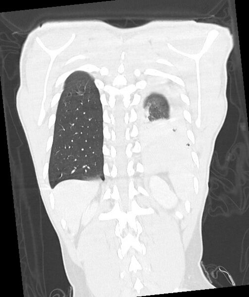 File:Arrow injury to the chest (Radiopaedia 85367-100975 Coronal lung window 106).jpg