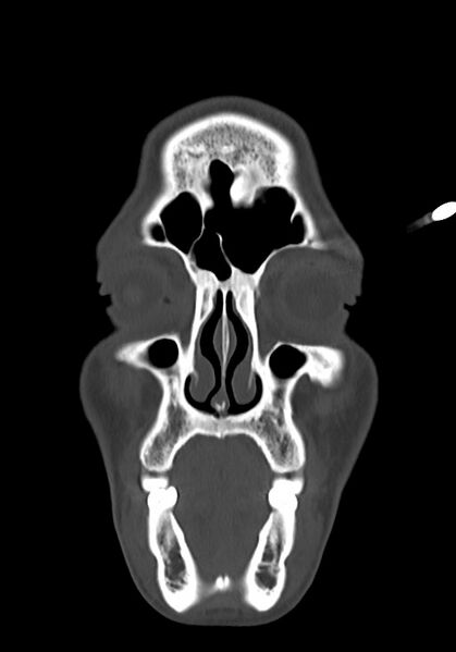 File:Arrow injury to the head (Radiopaedia 75266-86388 Coronal bone window 21).jpg