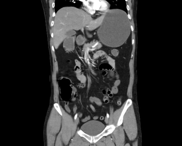 File:Arterial occlusive mesenteric ischemia (Radiopaedia 84641-100060 B 24).jpg