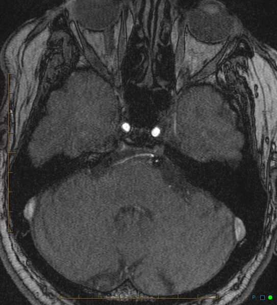File:Artifactual basilar artery stenosis due to metallic stent (Radiopaedia 31206-31922 Axial MRA 5).jpg