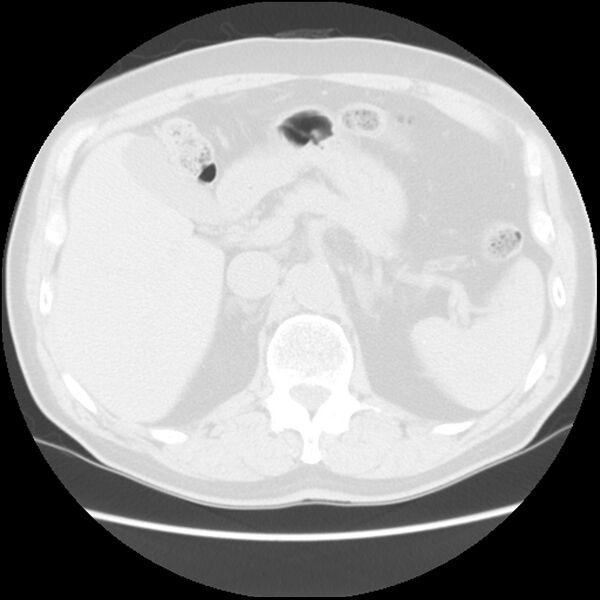 File:Asbestos-related pleural plaques (Radiopaedia 39069-41255 Axial lung window 73).jpg