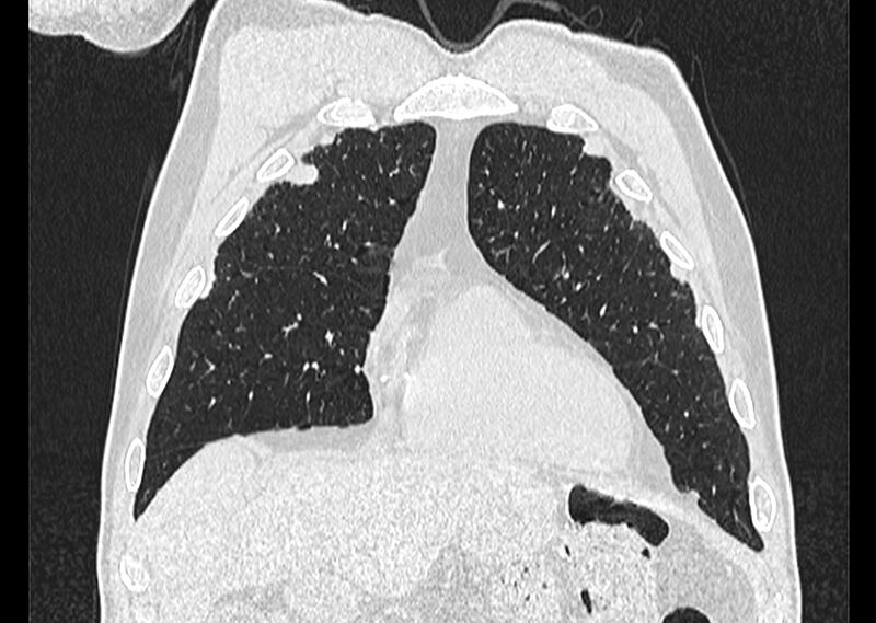 File:Asbestos pleural placques (Radiopaedia 57905-64872 Coronal lung window 59).jpg