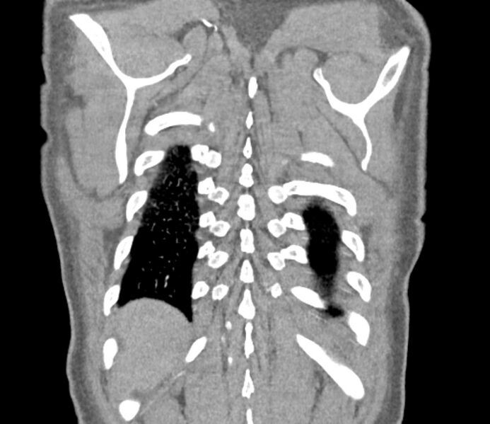 File:Ascending aortic aneurysm (Radiopaedia 86279-102297 B 60).jpg