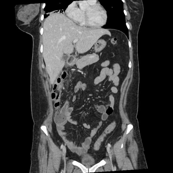 File:Ascending retrocecal appendicitis with liver abscesses (Radiopaedia 60066-67615 C 28).jpg