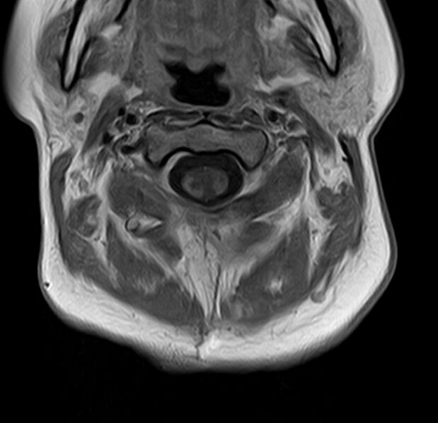 File:Astrocytoma - spinal cord (Radiopaedia 69769-79758 Axial T1 C+ 5).jpg