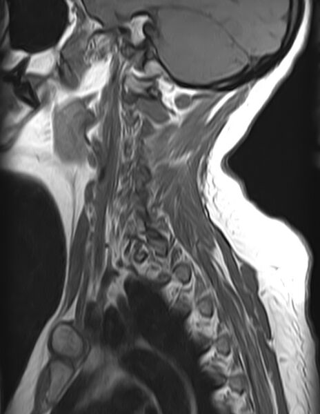 File:Astrocytoma - spinal cord (Radiopaedia 69769-79758 Sagittal T1 11).jpg
