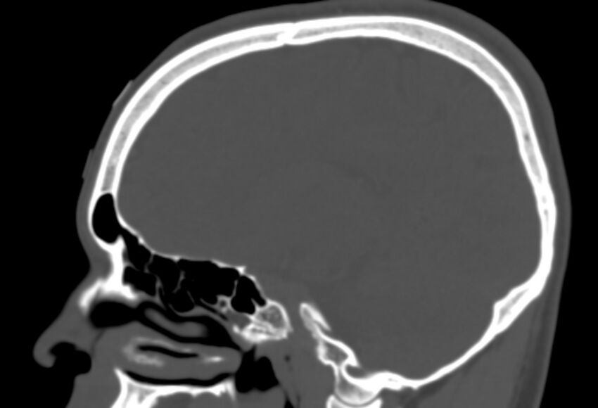 Asymptomatic occipital spur (Radiopaedia 87753-104201 Sagittal bone window 126).jpg