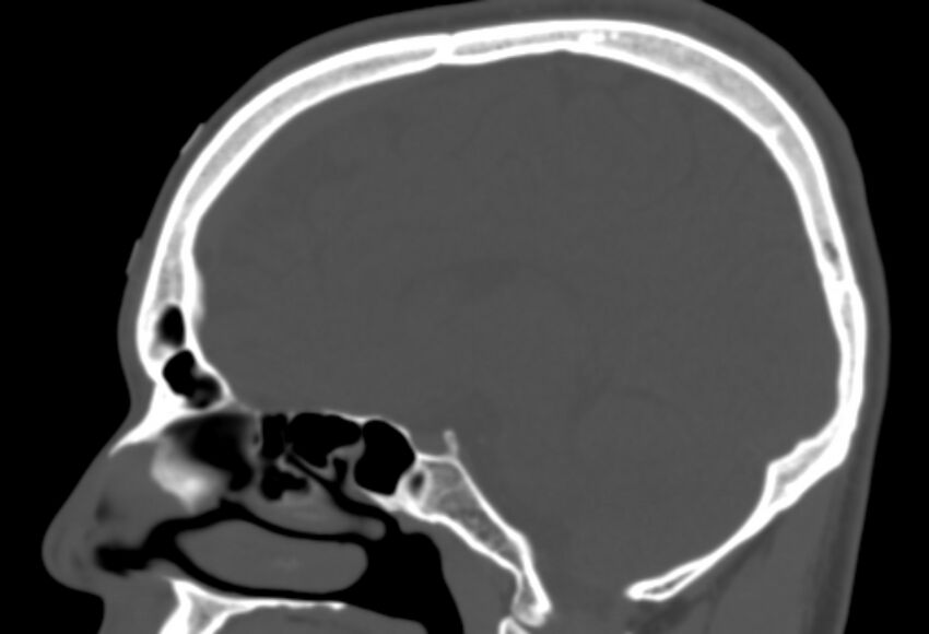 Asymptomatic occipital spur (Radiopaedia 87753-104201 Sagittal bone window 138).jpg