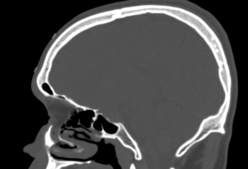 Asymptomatic occipital spur (Radiopaedia 87753-104201 Sagittal bone window 177).jpg