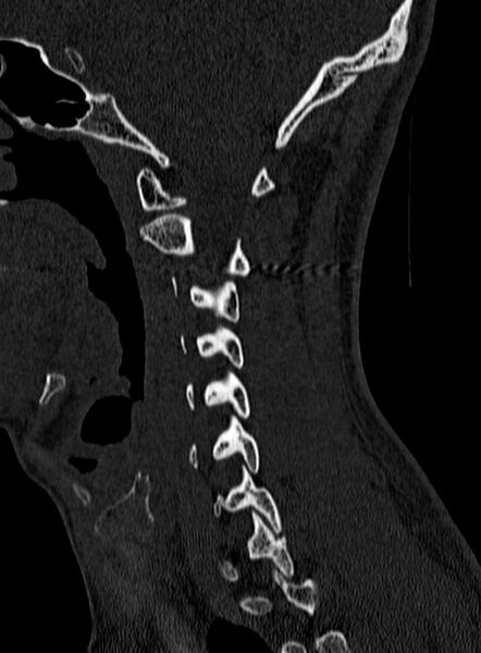 File:Atlantoaxial subluxation (Radiopaedia 44681-48450 Sagittal bone window 33).jpg