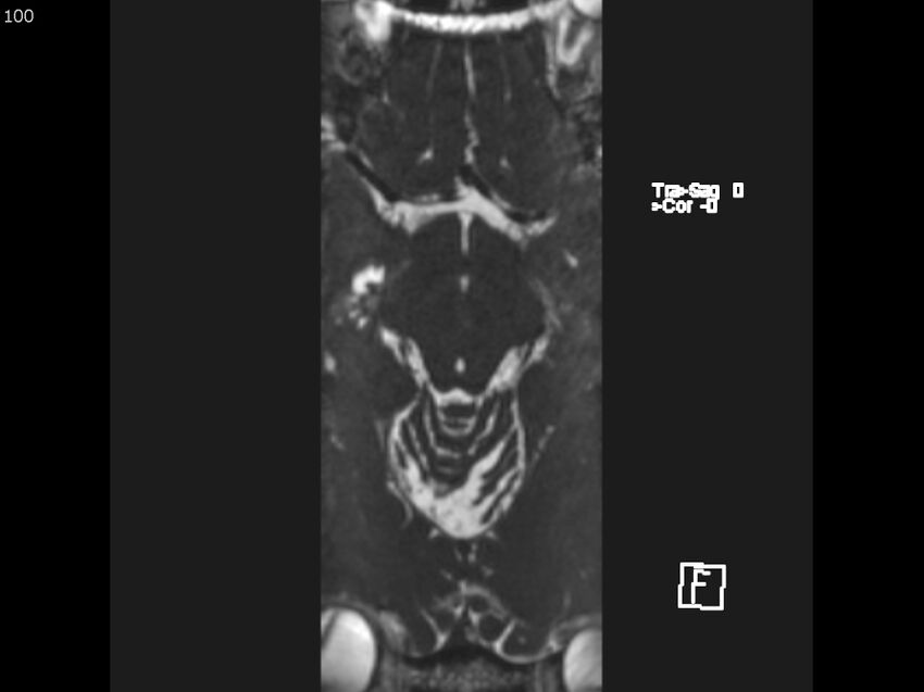 Atypical meningioma - intraosseous (Radiopaedia 64915-74572 Axial CISS 100).jpg