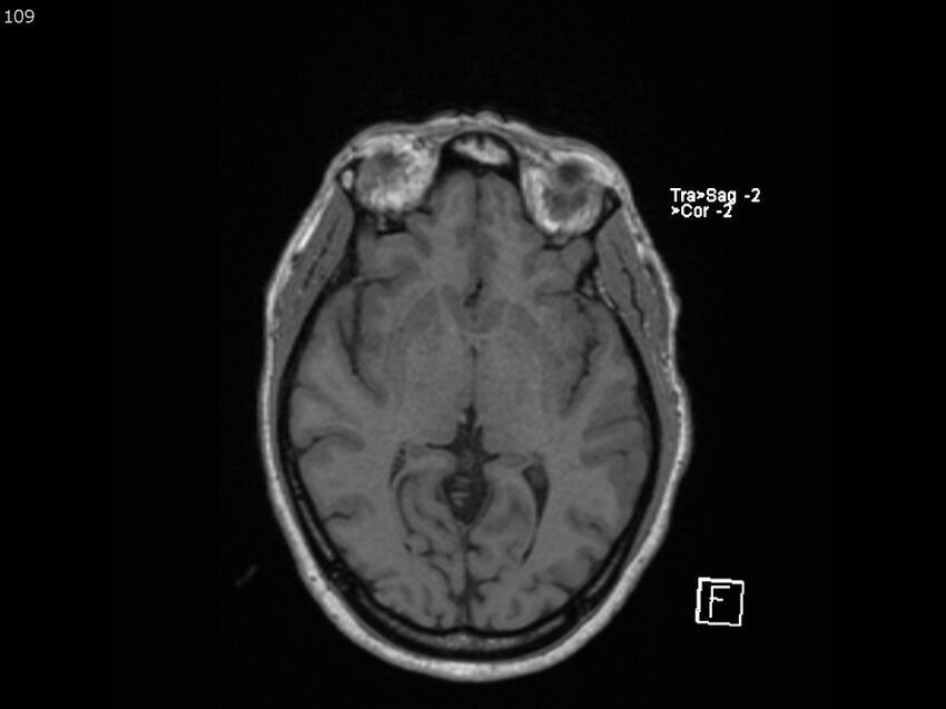 Atypical meningioma - intraosseous (Radiopaedia 64915-74572 Axial T1 109).jpg