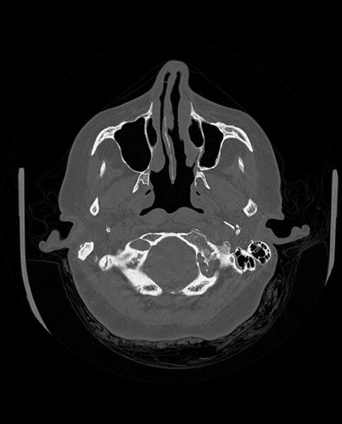 File:Automastoidectomy with labyrinthine fistula (Radiopaedia 84143-99411 Axial non-contrast 58).jpg