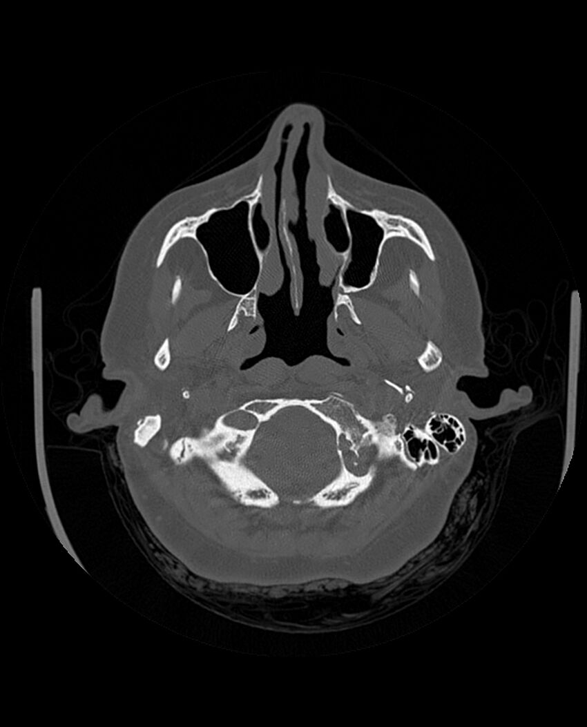 Automastoidectomy with labyrinthine fistula (Radiopaedia 84143-99411 Axial non-contrast 58).jpg