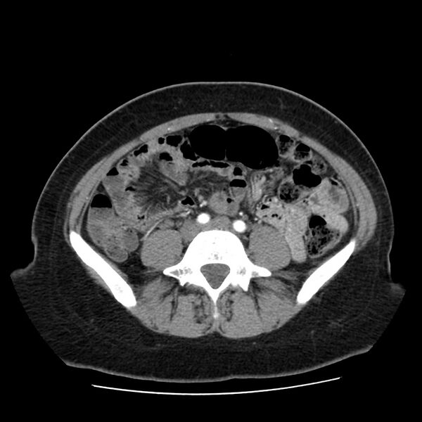 File:Autosomal dominant polycystic kidney disease (Radiopaedia 23061-23093 B 46).jpg