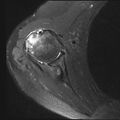 Avulsion fracture - greater tuberosity of humerus (Radiopaedia 71216-81515 Axial PD fat sat 9).jpg