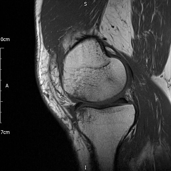 File:Avulsion fracture of the fibular head (Radiopaedia 74804-85808 D 12).jpg