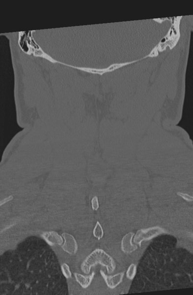 File:Axis peg fracture (type 3) and atlas lateral mass (type 4) fracture (Radiopaedia 37474-39324 Coronal bone window 50).png