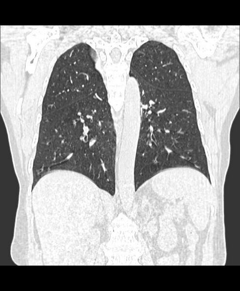 File:Azygos fissure and azygos lobe (Radiopaedia 41841-44832 Coronal lung window 14).jpg