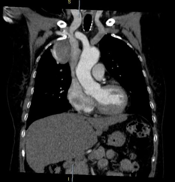 File:Azygos vein aneurysm (Radiopaedia 77824-90130 C 12).JPG