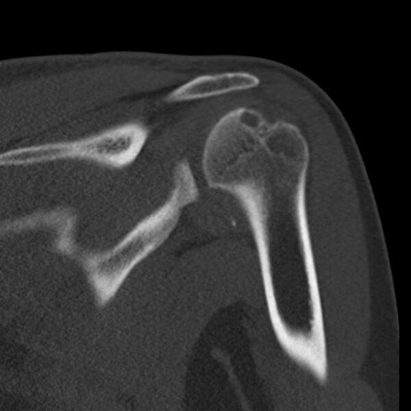 File:Bankart lesion (Radiopaedia 22771-22798 Coronal bone window 28).jpg