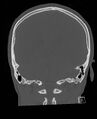 Base of skull fracture with bilateral Le Fort fractures (Radiopaedia 47094-51638 Coronal bone window 32).jpg
