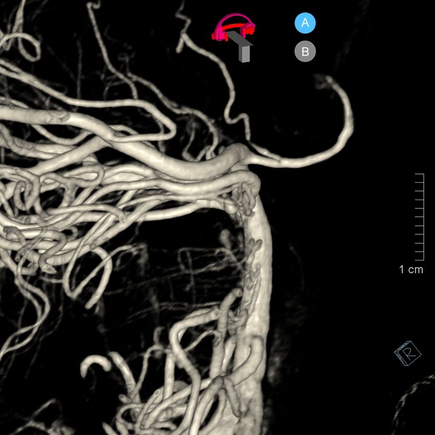 Basilar artery perforator aneurysm (Radiopaedia 82455-97734 3D view left VA 139).jpg