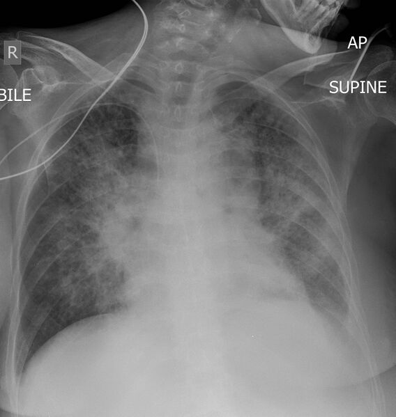 File:Bat's wings of pulmonary edema (Radiopaedia 26492).jpg